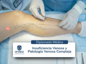 insuficiencia_venosa.webp